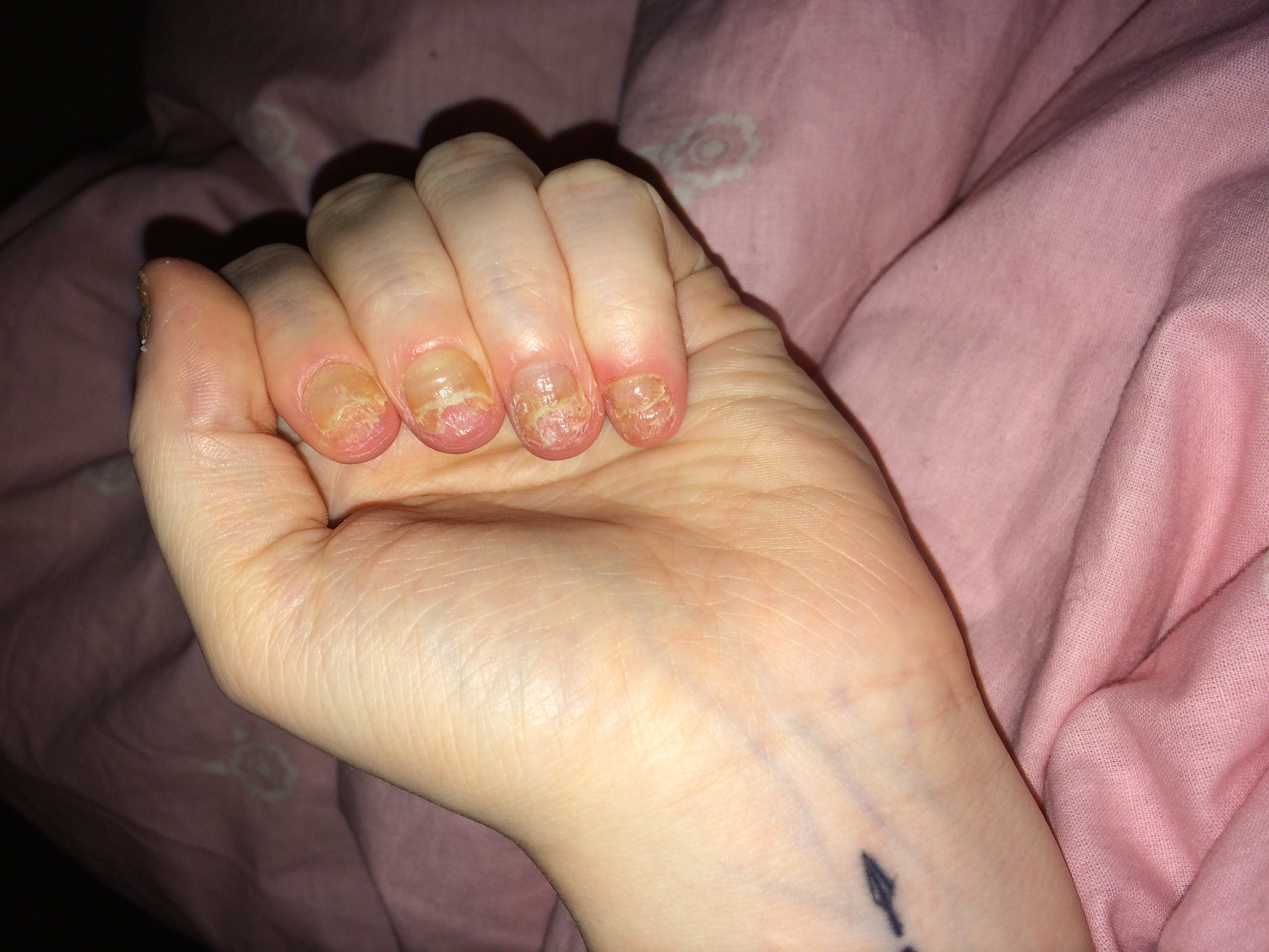 Nagel Nach Kunstnageln Vollig Kaputt Wachsen Sie Normal Nach Nageldesign