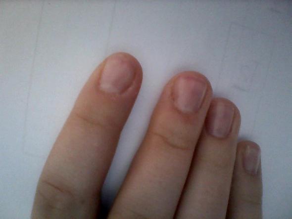 Ich hoffe man kann es erkennen besonders am Zeigefinger - (Gesundheit, Körper, Beauty)