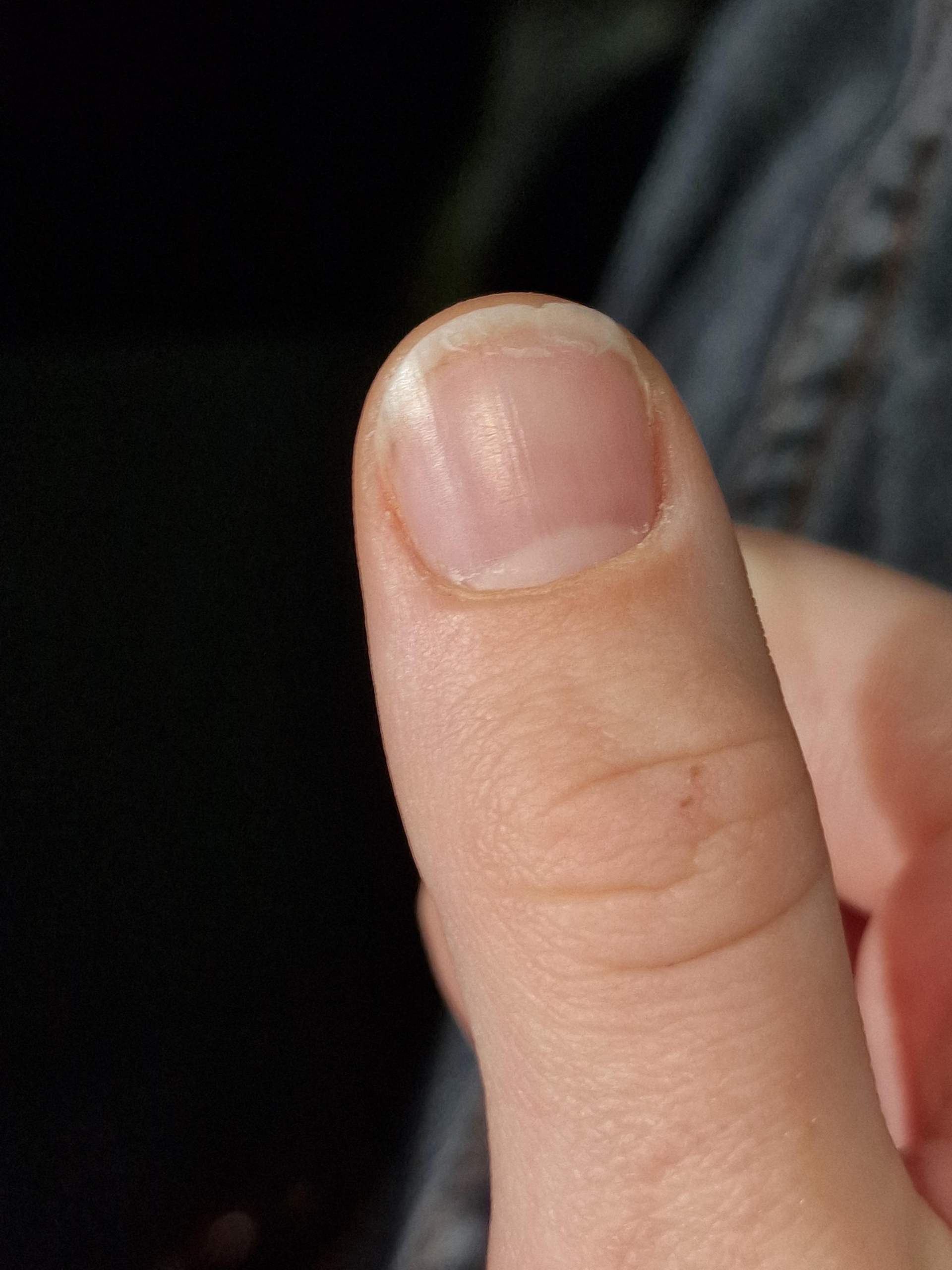 Nägel, was kann man dagegen machen? (Pflege, Finger, Fingernägel)