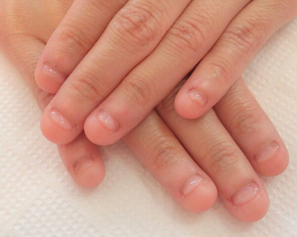 Nagelkauen Aufhoren Aber Wieee Frauen Fingernagel