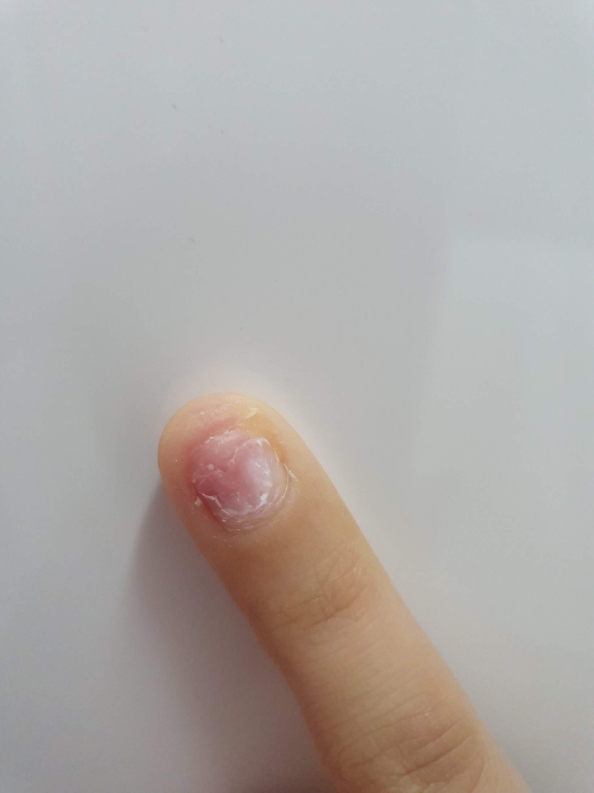 Nagel bis zur Hälfte abgebrochen, was