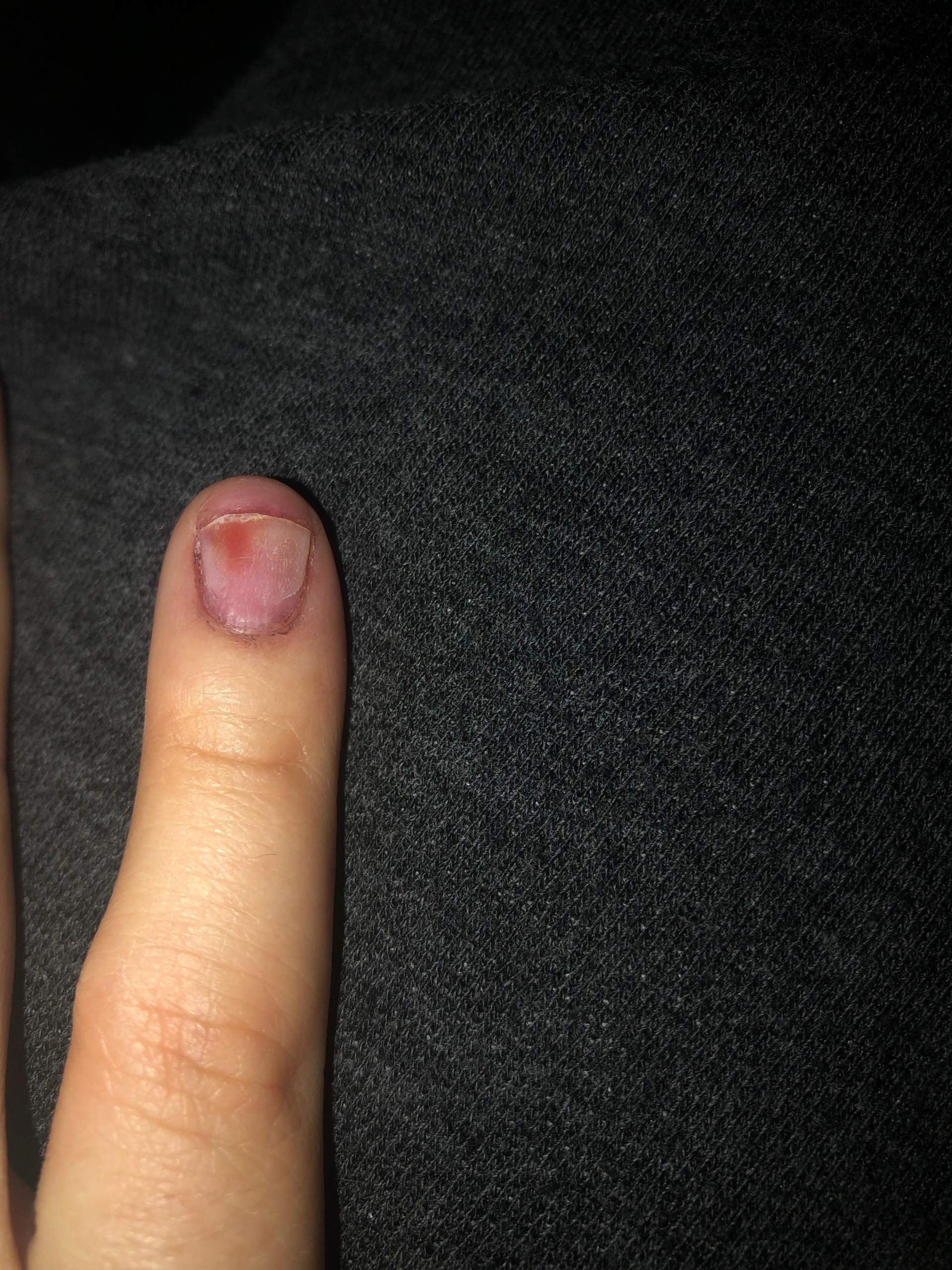 Finger In Tür Eingeklemmt Nagel Blau Nagel blau, nach abgerissenen gelnagel? (Entzündung, Nägel)