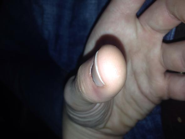 Hier ist beim genauen gucken der hintere Nagel weiter oben als der vordere - (Gesundheit, Unfall, Nägel)