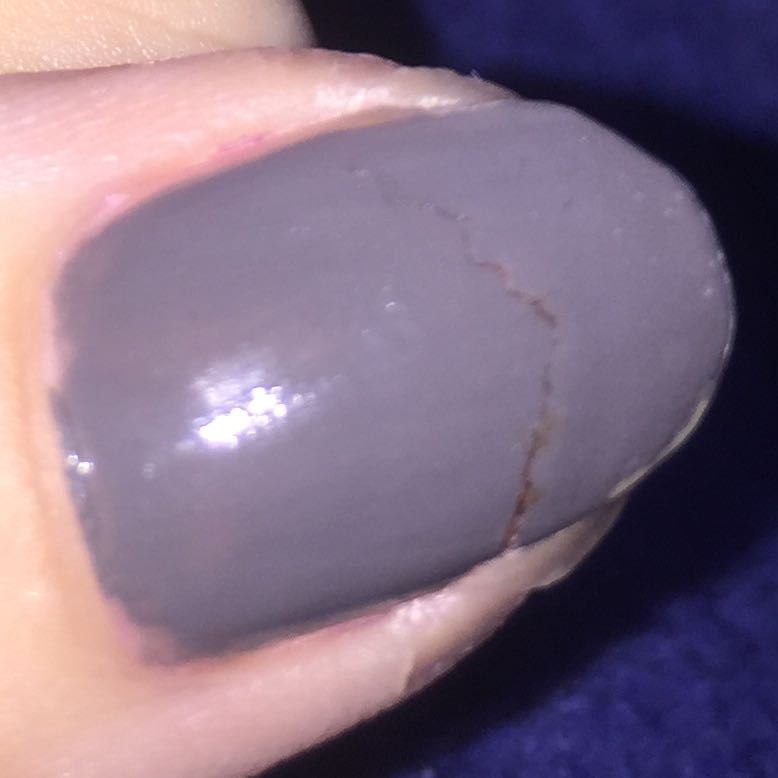 Nagel Eingerissen Was Tun Hand Nagel Finger Nagel Eingerissen Was Tun Hand Nagel Finger