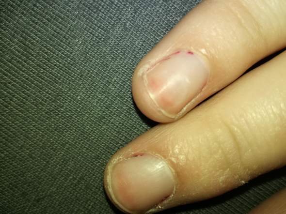 nagel errotet gesundheit und medizin fingernagel 
