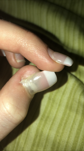 Nagel Komplett Rausgerissen Wachst Er Wieder Nach Nagel Nagel Komplett Rausgerissen Wachst Er Wieder Nach Nagel