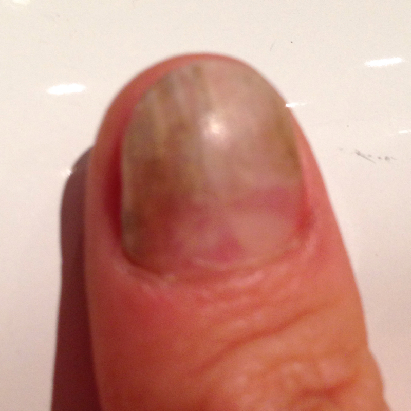 Nagel löst sich auf. (Arzt, Krankenhaus, Nägel) Nagel löst sich auf. (Arzt, Krankenhaus, Nägel)