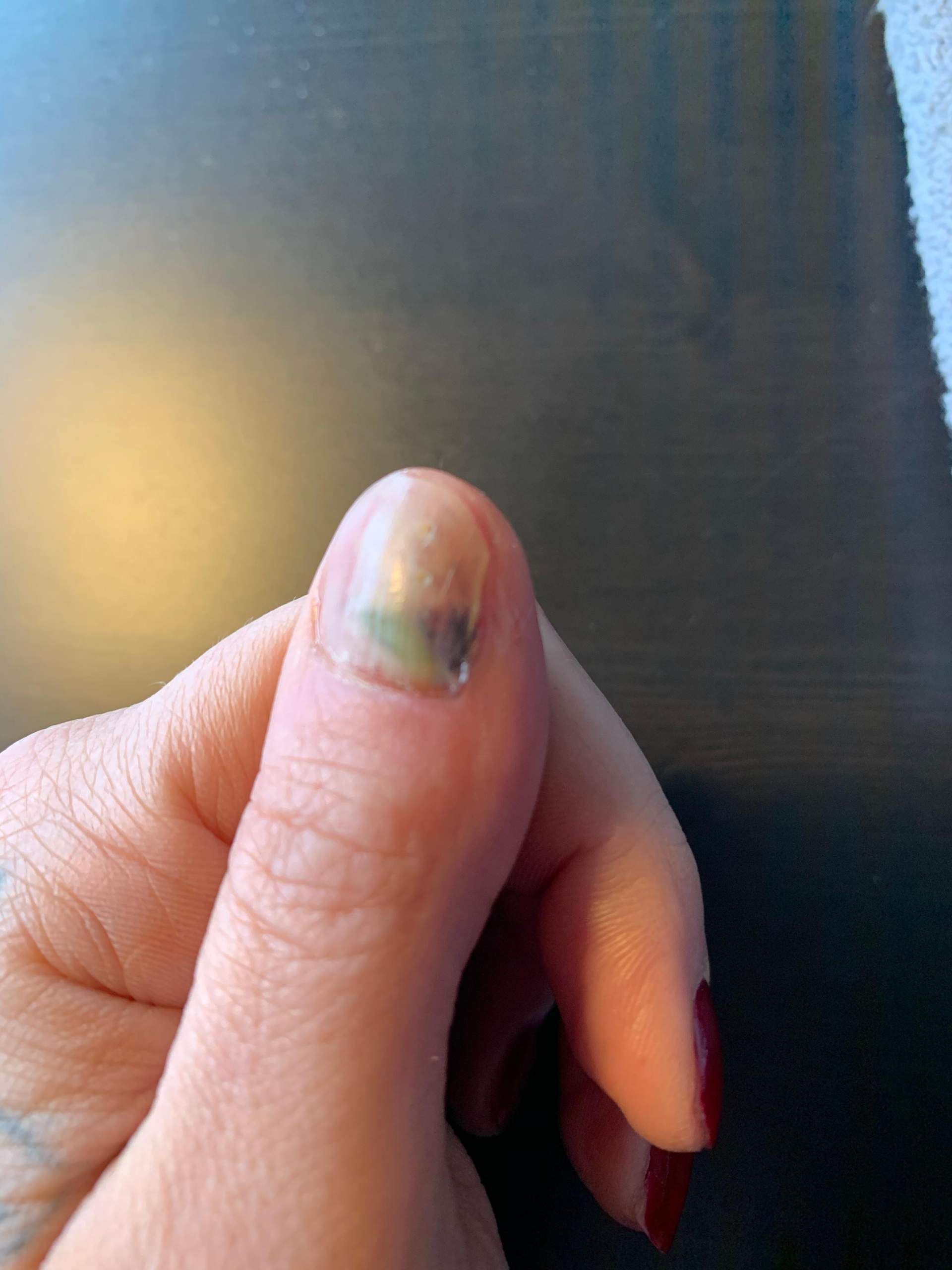 nagel lost sich von nagelbett ab hilfe gesundheit und medizin nagelstudio medizinisch