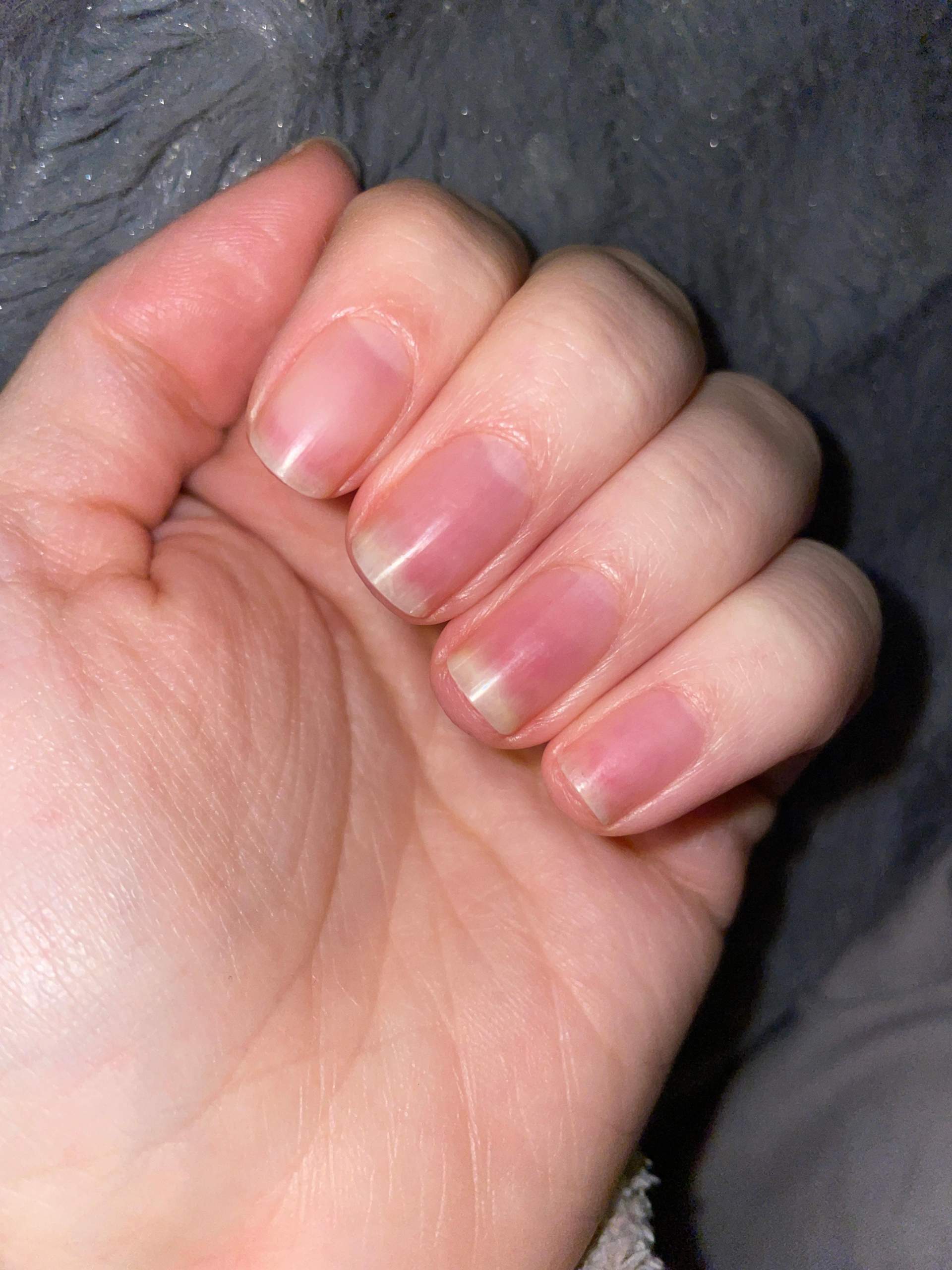 Nagel löst sich von Nagelbett, was tun? (Haut, Nägel, Hautarzt) Nagel löst sich von Nagelbett, was tun? (Haut, Nägel, Hautarzt)