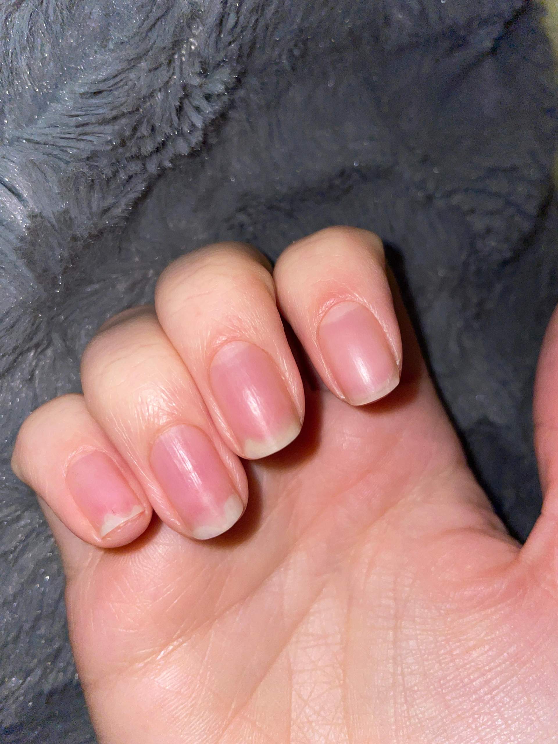 Nagel löst sich von Nagelbett, was tun? (Haut, Nägel, Hautarzt) Nagel löst sich von Nagelbett, was tun? (Haut, Nägel, Hautarzt)