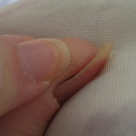 nagel wachst falsch haut nagel finger