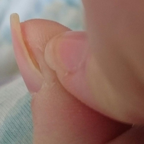 nagel wachst falsch haut nagel finger