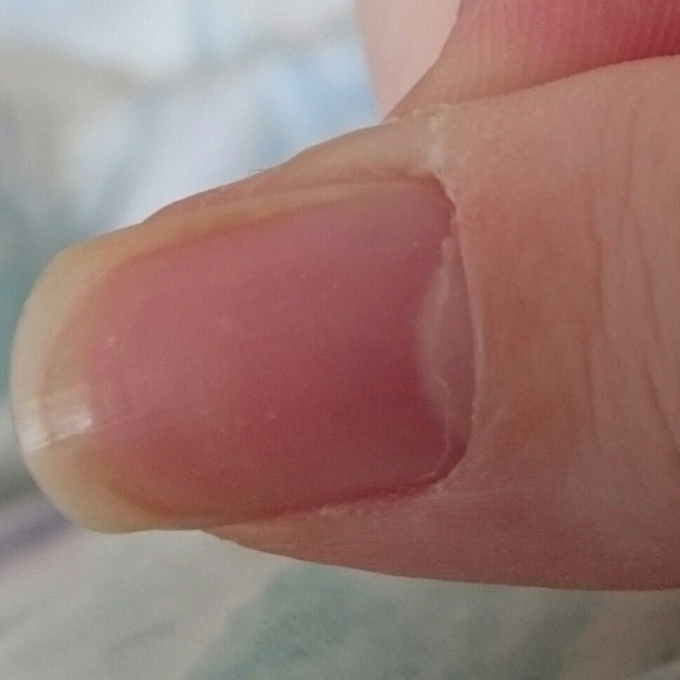 Nagel wächst falsch? (Haut, Nägel, Finger) Nagel wächst falsch? (Haut, Nägel, Finger)