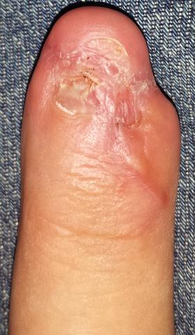 Nagel Wachst Nur Noch Teils Nach Komplett Entfernen Lassen Gesundheit Hand Nagel Wachst Nur Noch Teils Nach Komplett Entfernen Lassen Gesundheit Hand