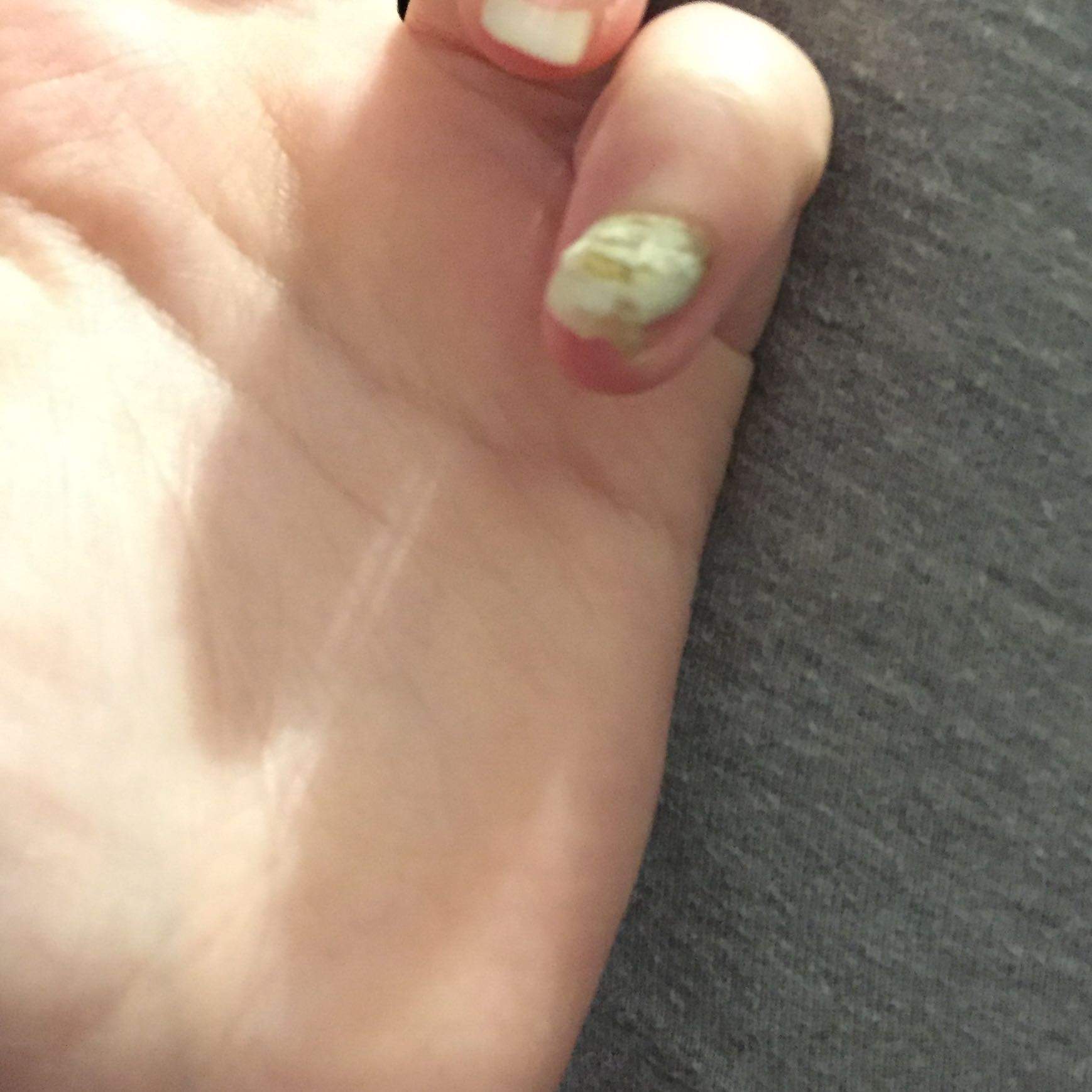 Nagel wächst schief raus was tun? (Nägel) Nagel wächst schief raus was tun? (Nägel)