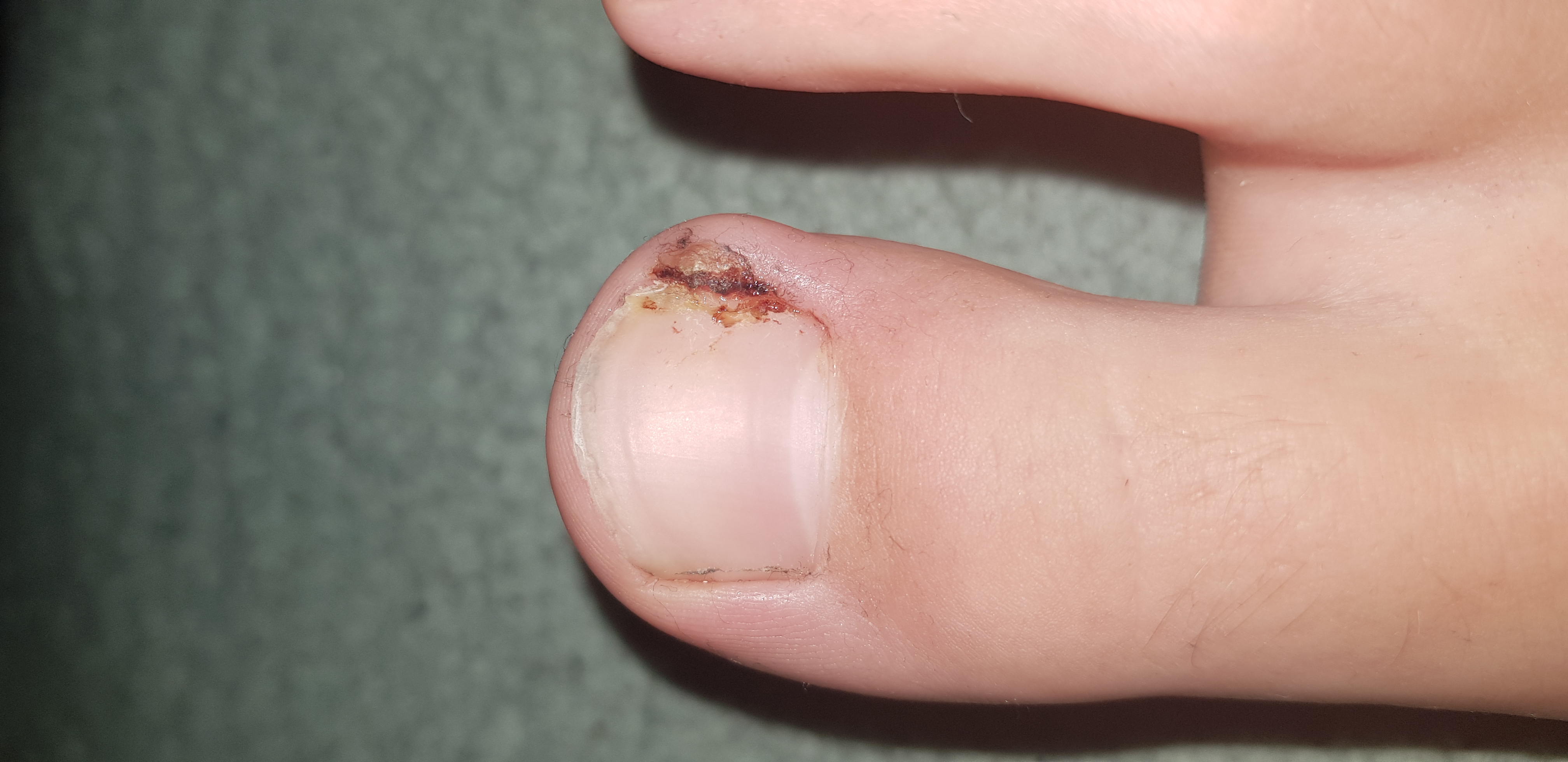 Nagelbett Entzündung oder ein eingewachsener nagel?