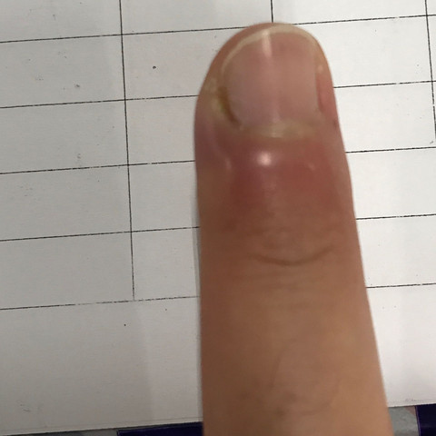 Nagelbett Entzundung Schlimm Gesundheit Und Medizin Arzt Nagelbettentzundung Nagelbett Entzundung Schlimm Gesundheit Und Medizin Arzt Nagelbettentzundung