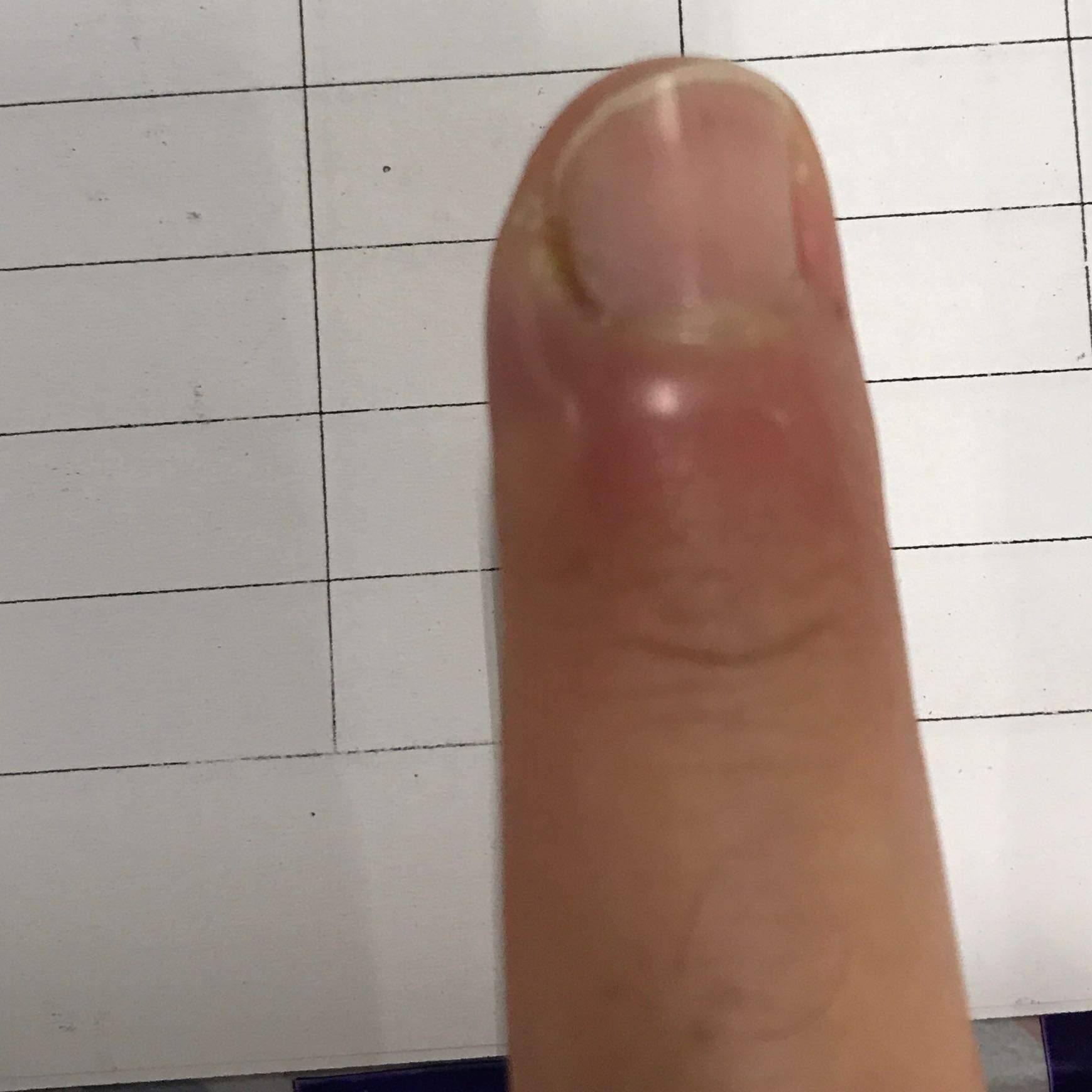 Nagelbett Entzundung Schlimm Gesundheit Und Medizin Arzt Nagelbettentzundung Nagelbett Entzundung Schlimm Gesundheit Und Medizin Arzt Nagelbettentzundung