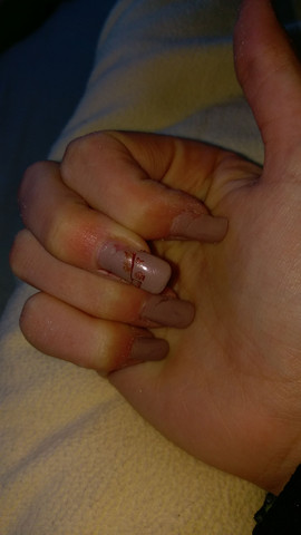 Was tun nagel abgebrochen gel Abgebrochene Fingernägel