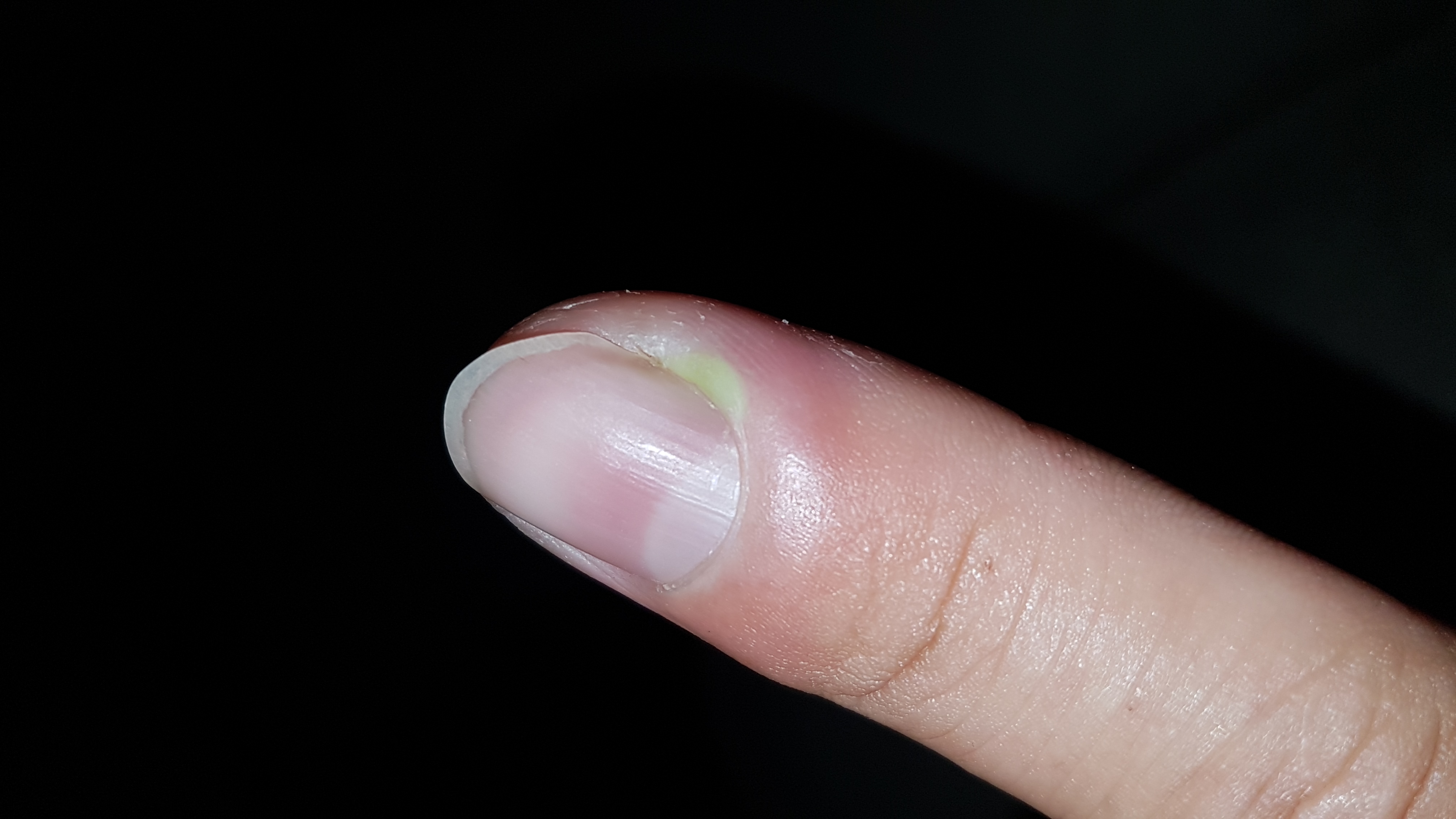 Eiter Im Finger Was Tun - mobinspire