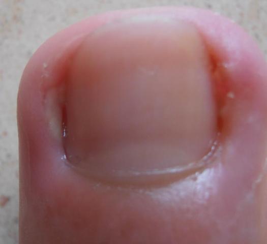 Nagelbettentzundung Eiter Blut Was Tun Nagelbettentzundung Eiter Blut Was Tun