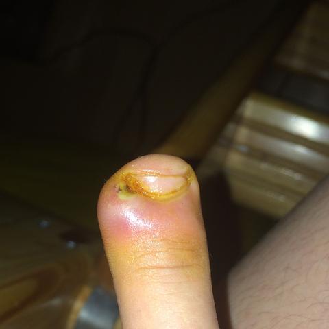 MeinMkttelfinger 
(Das gelbe auf dem Nagel ist Salbe)
 - (Nägel, Bett, Nagelbettentzündung)