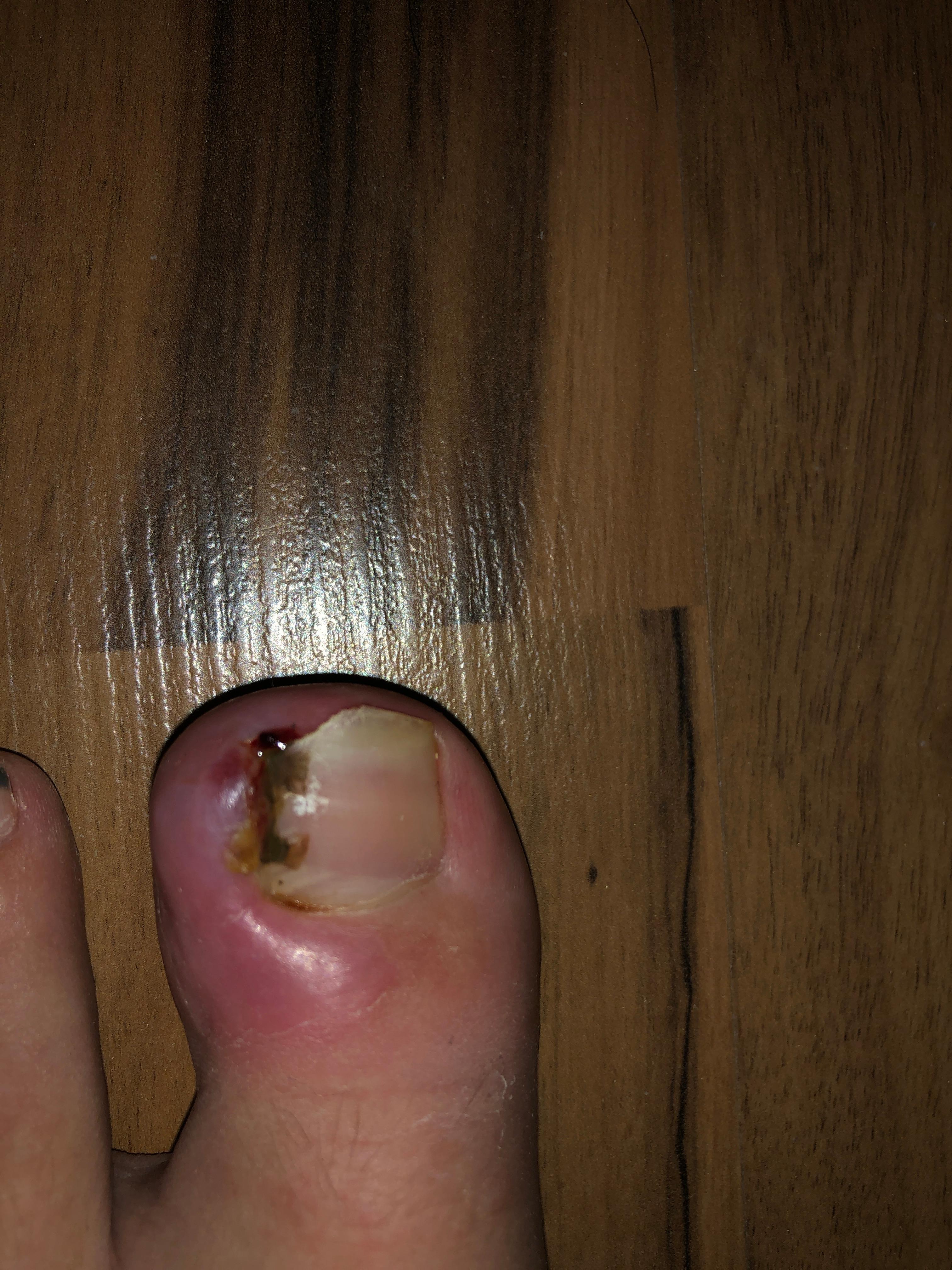 Nagelbettentzundung Mit Wildem Fleisch Gesundheit Und Medizin Gefahrlich Eingewachsener Zehnagel Nagelbettentzundung Mit Wildem Fleisch Gesundheit Und Medizin Gefahrlich Eingewachsener Zehnagel