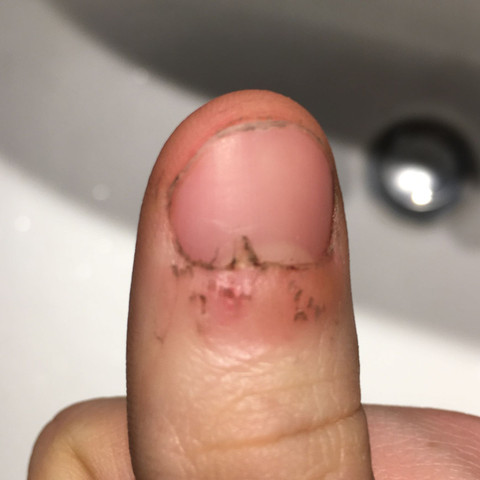 Nagelhaut Immer Entzundet Gesundheit Und Medizin Medizin Arzt