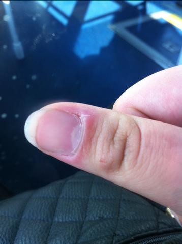 Nagelhaut Knabbern Beauty