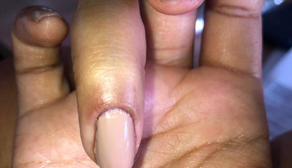 Nagelhaut wächst nicht mehr? (Gesundheit und Medizin, Nägel)