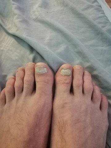 Nagelpilz Ciclopoli Nagelpilz Ciclopoli