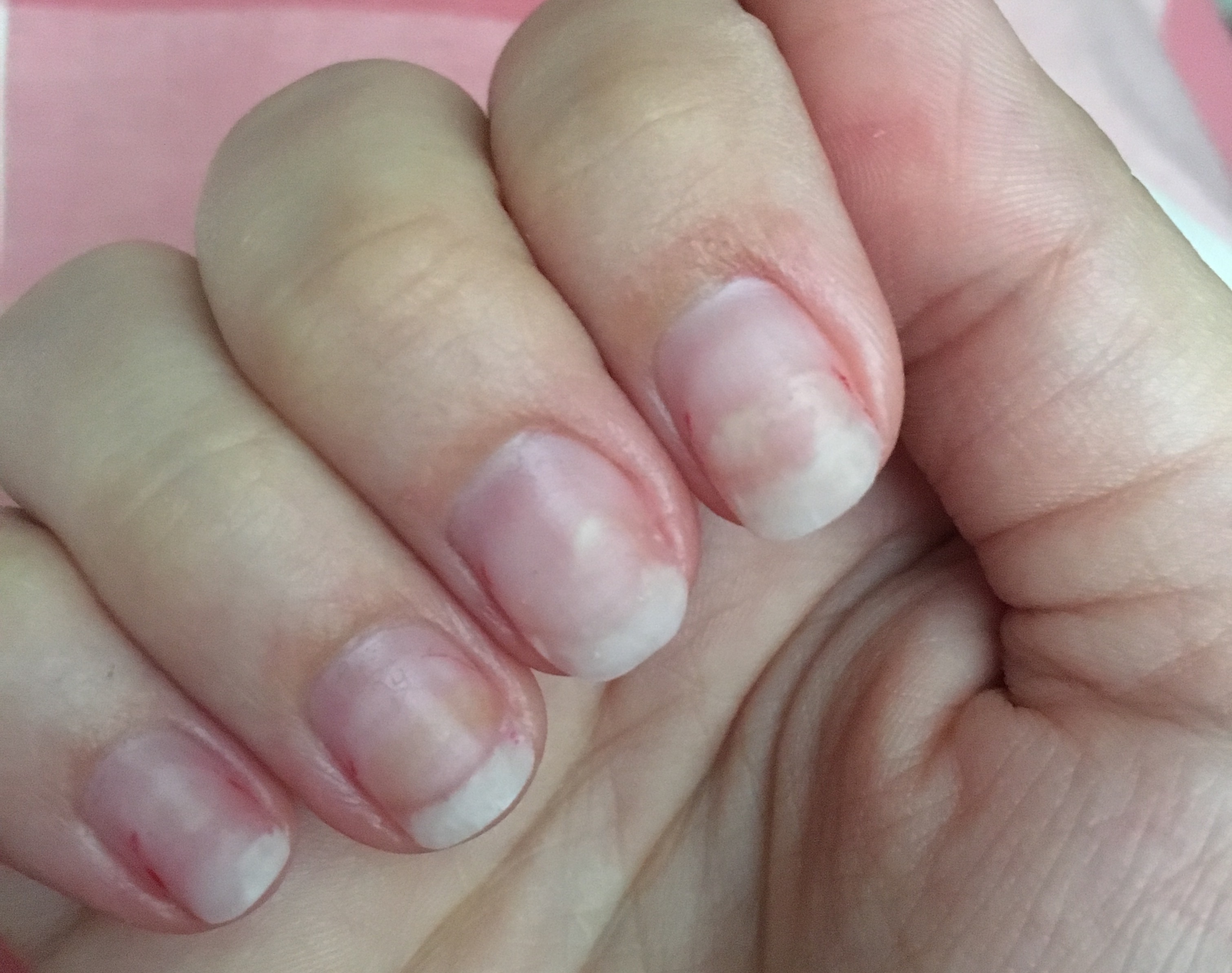 Nagelpilz nach Nagelmodellage? (Gesundheit und Medizin) Nagelpilz nach Nagelmodellage? (Gesundheit und Medizin)