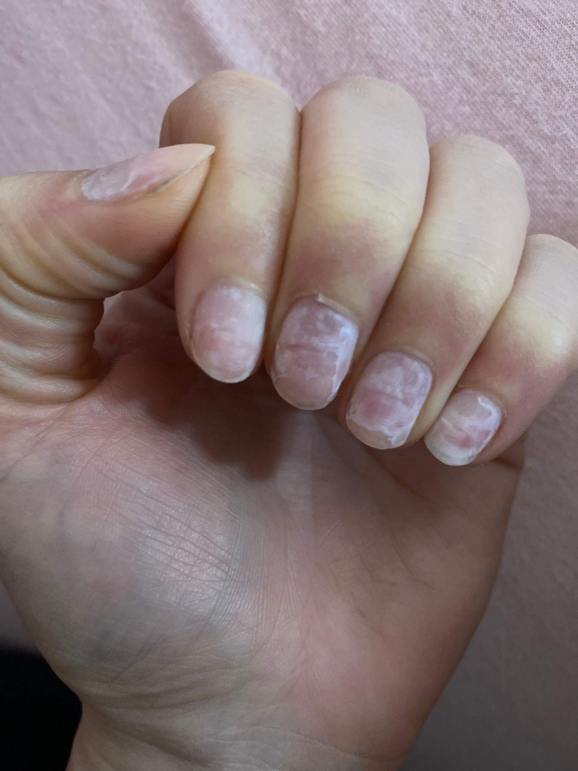 Nagelpilz oder Beschdigte Ngel? (Fingerngel, Acrylngel)