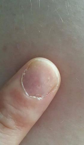 Nagelpilz Oder Etwas Anderes Gesundheit Fingernagel Nagelpilz Oder Etwas Anderes Gesundheit Fingernagel