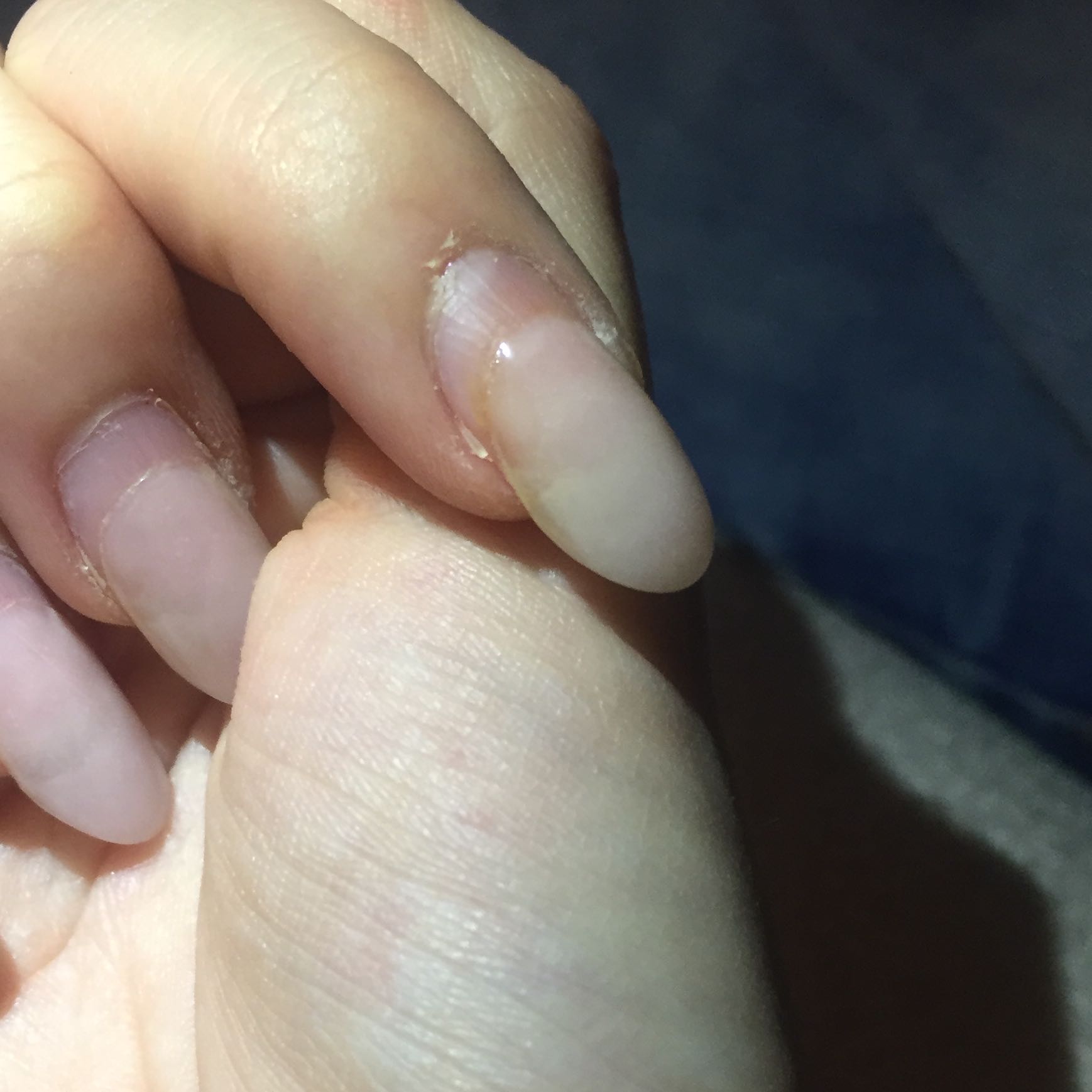 Nagelpilz unter den Gelnägeln? (Nägel, Infektion, Nagelstudio) Nagelpilz unter den Gelnägeln? (Nägel, Infektion, Nagelstudio)