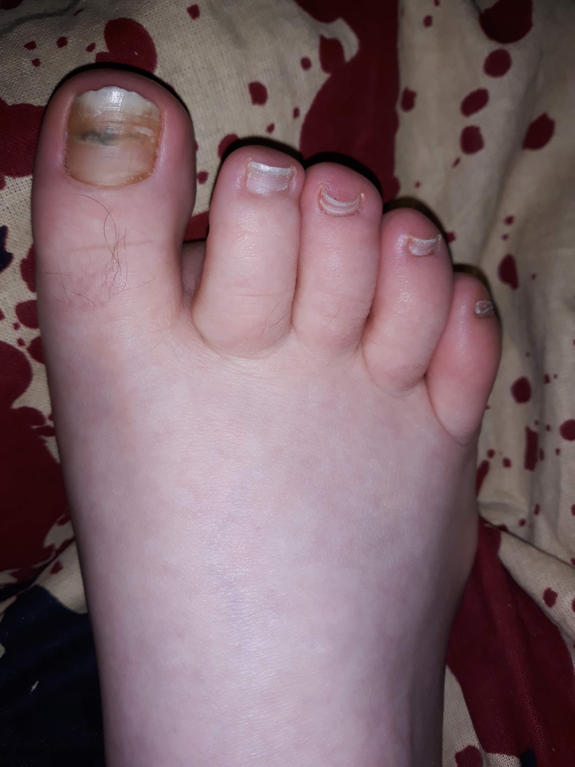 Nagelpilz,Bluterguss? (Zehennagel)