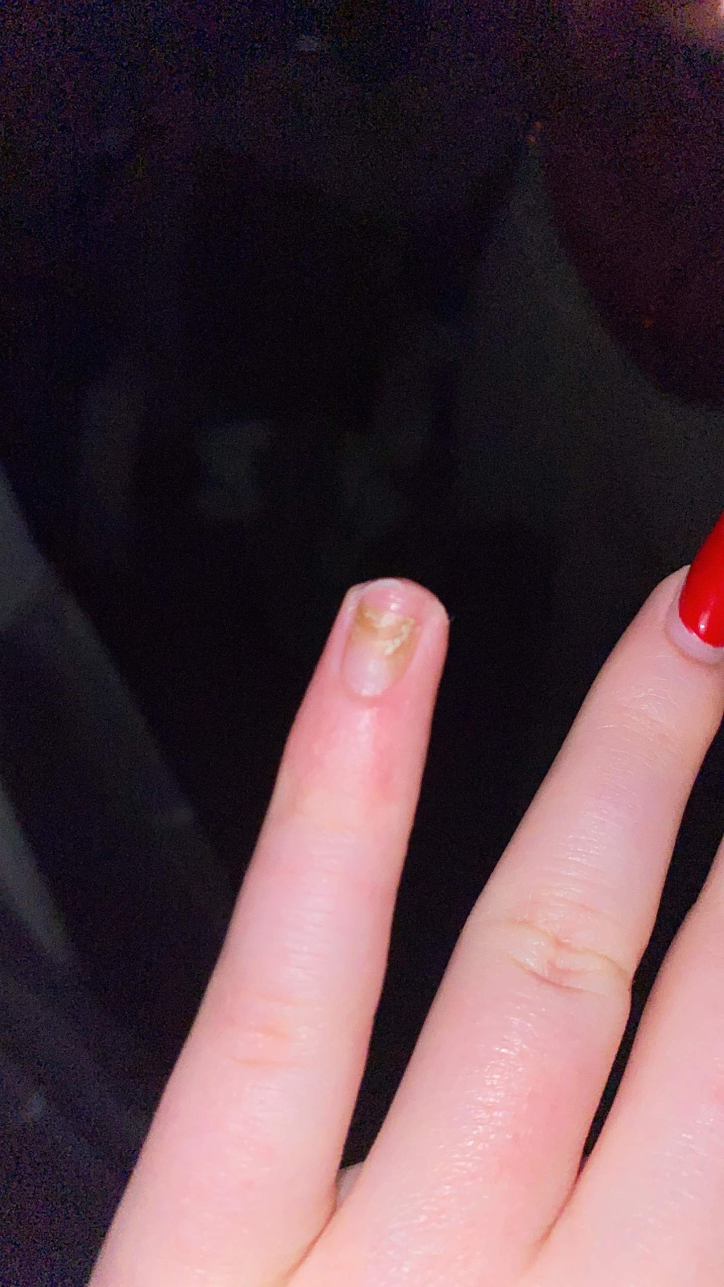 Nagelverfärbung nach gelnägel? (Nägel, Fingernägel, Nagelstudio)