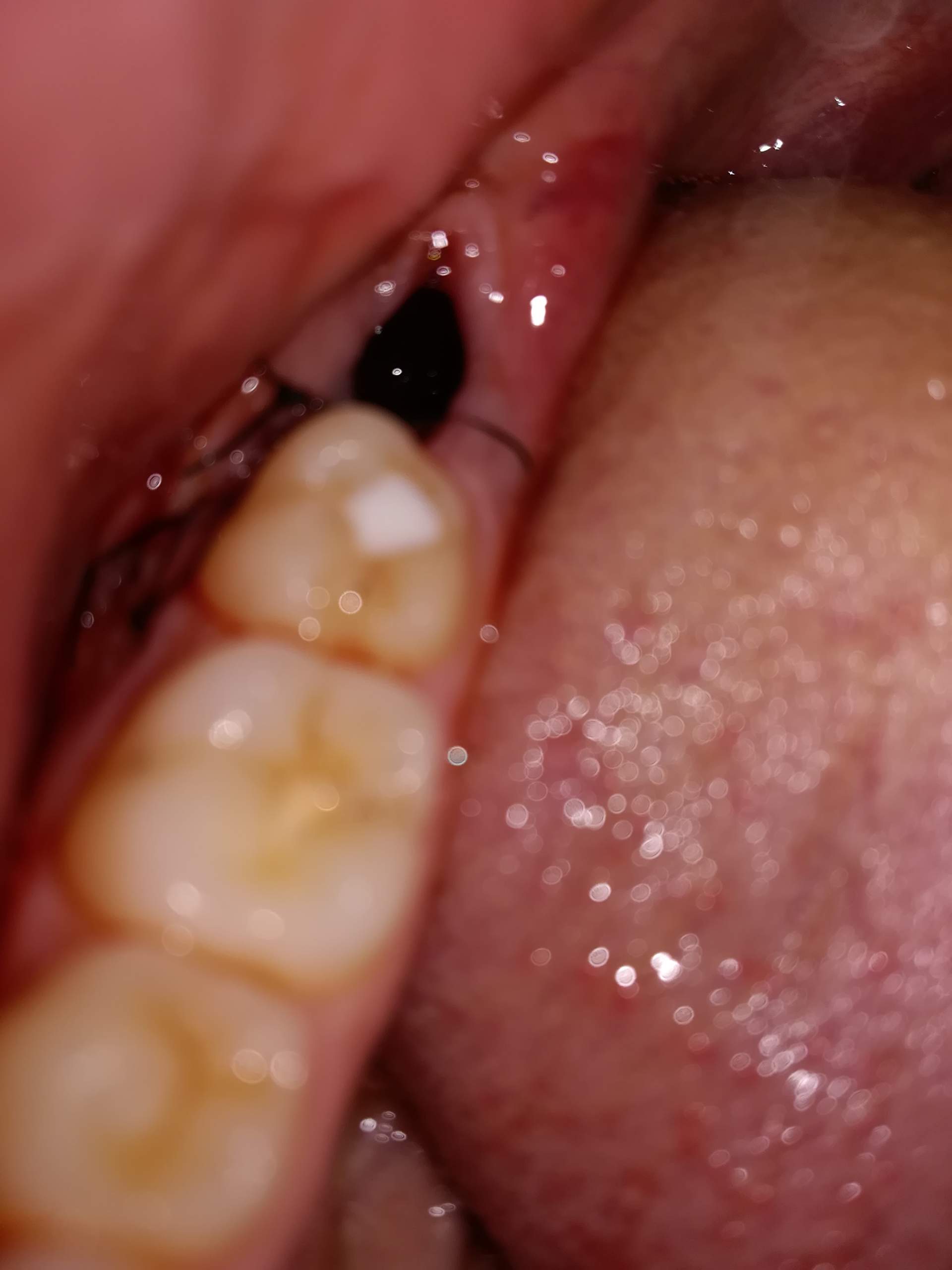 Naht vergessen nach Weisheitszahn-OP? (Zähne, Zahnmedizin, Weisheitszähne)