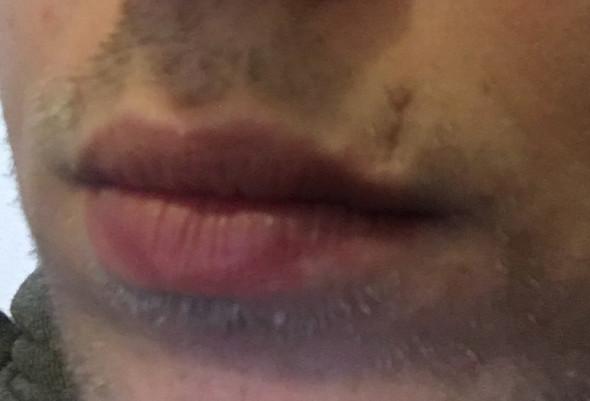 Narbe An Der Oberlippe Entfernen Lassen Medizin Operation Lippe