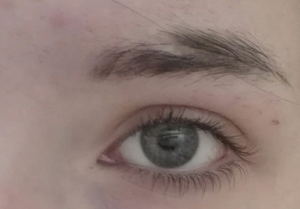 Narbe Auf Der Linken Augenbraue Was Tun Narben Augenbrauen