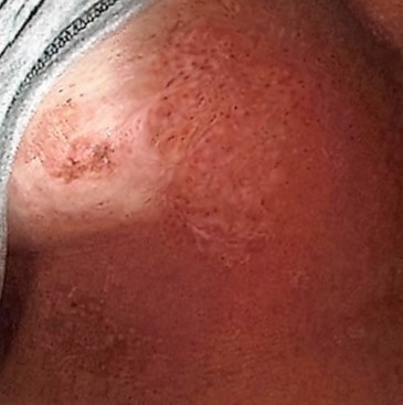 Narbe Mit Tattoo Uberdecken Narben