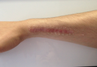 Narbe nach 3 Jahren immer noch nicht geheilt (Narben, Bruch)