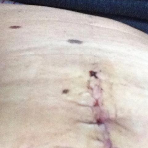 Narbe Verheilt Oder Nicht Gesundheit Operation Narben Narbe Verheilt Oder Nicht Gesundheit Operation Narben