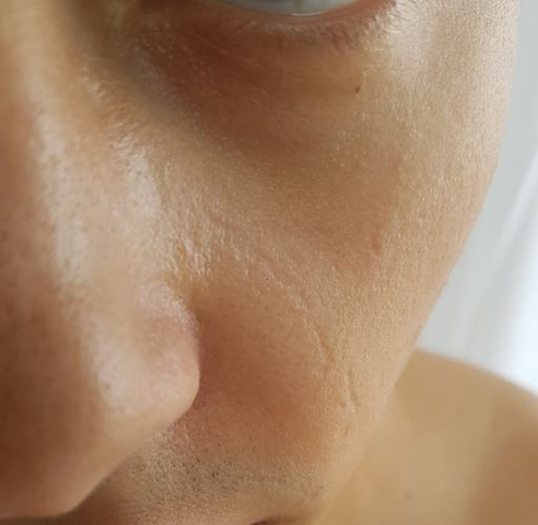 Narben Gesicht Behandelbar Medizin Arzt Behandlung