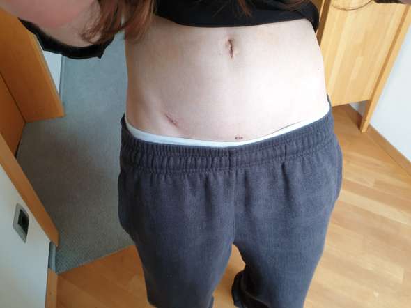 Narben 2 Wochen Nach Laparoskopischer Blinddarmop Normal Gesundheit Und Medizin Haut Blinddarm Narben 2 Wochen Nach Laparoskopischer Blinddarmop Normal Gesundheit Und Medizin Haut Blinddarm