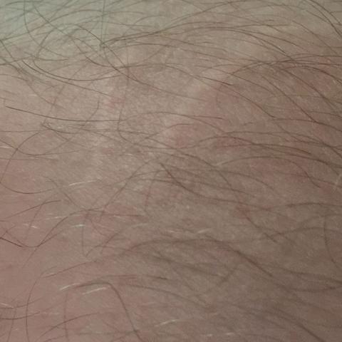 Bild 1 - (Gesundheit, Knie, Narben)