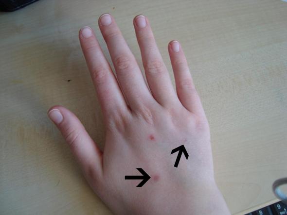 Hand - (Verletzung, Hand, Wunde)