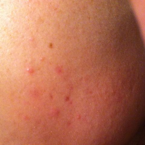 31+ Rote Flecken Nach Pickel Gehen Nicht Weg PNG