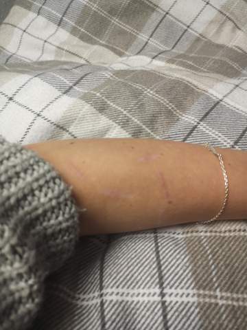 Narben Weg Narbenbehandlung Narben Weg Narbenbehandlung