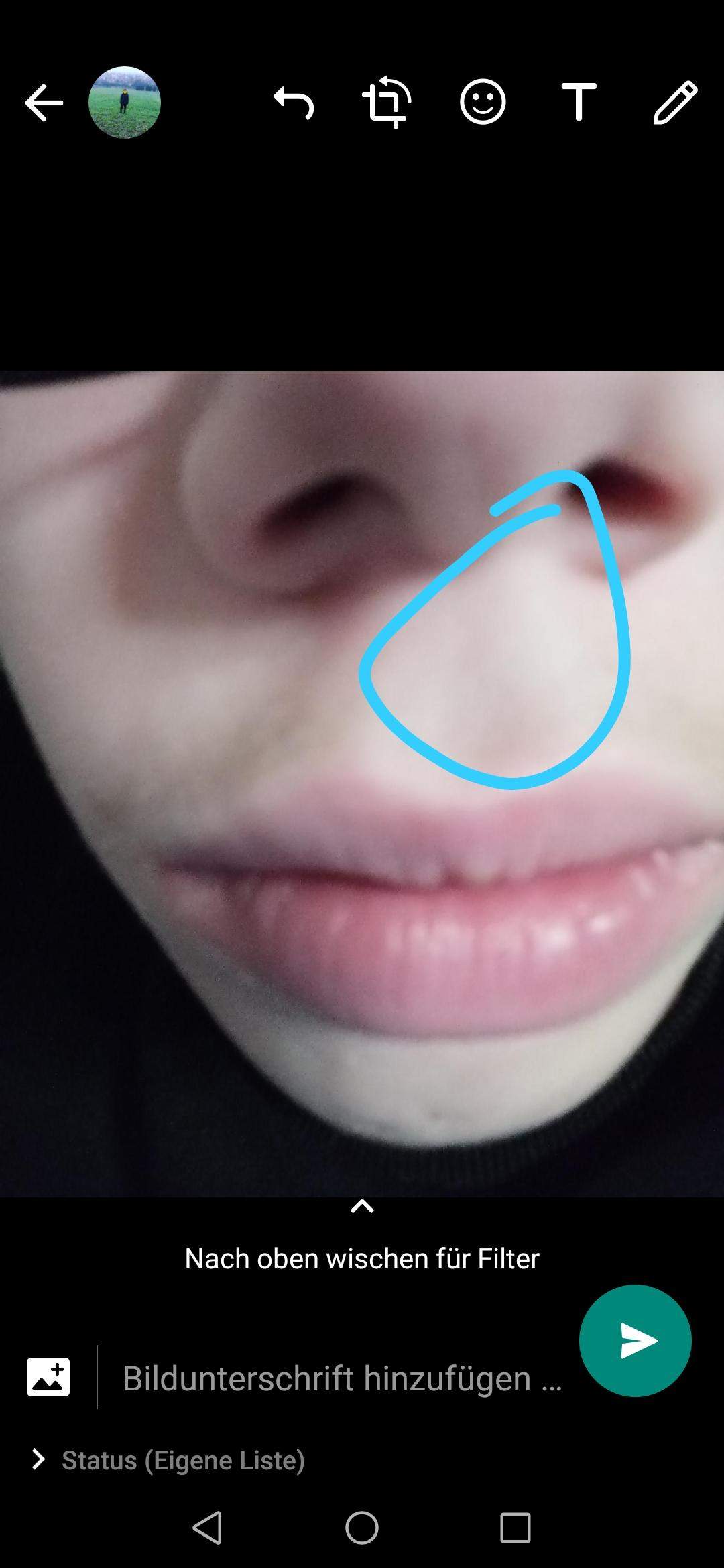 Tut Ein Tumor Weh Wenn Man Draufdrückt Unter den Nasenlöchern schmerzt es wenn man drauf drückt. Tumor? Lipom